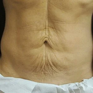 SkinTyte skin tightening before case 2
