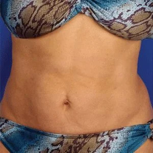 SkinTyte skin tightening results case 3