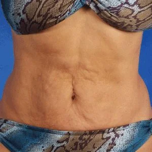 SkinTyte skin tightening before case 3