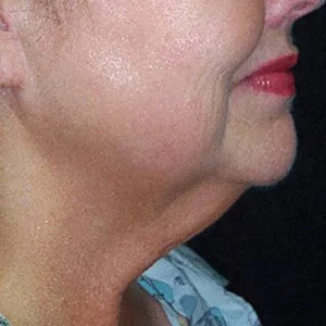 SkinTyte skin tightening results case 4