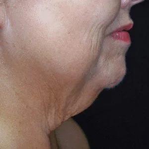 SkinTyte skin tightening before case 4
