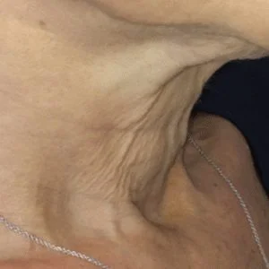 SkinTyte skin tightening results case 5
