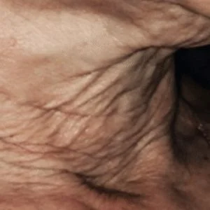SkinTyte skin tightening before case 5