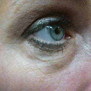 SkinTyte skin tightening results case 6