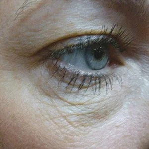 SkinTyte skin tightening before case 6