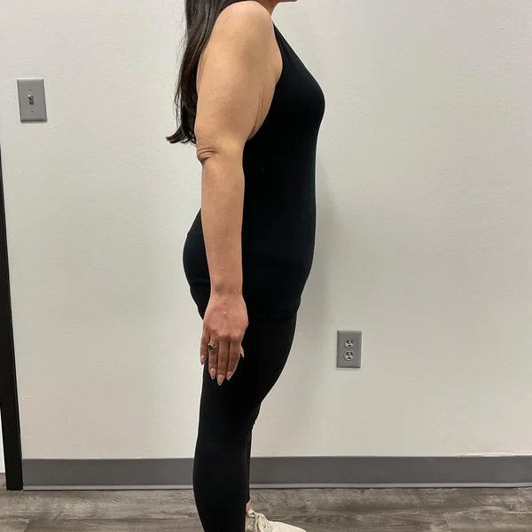 Semaglutide medical weight loss results case 3