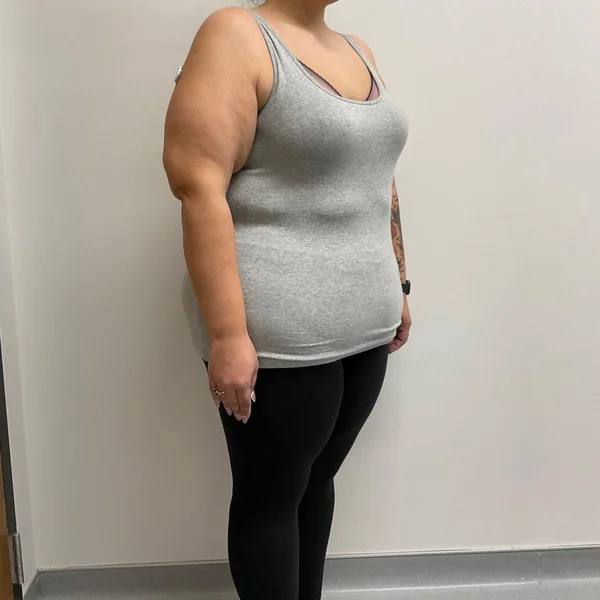 Semaglutide medical weight loss before case 3