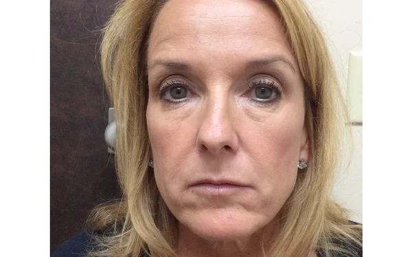 Forehead Wrinkles After treatment