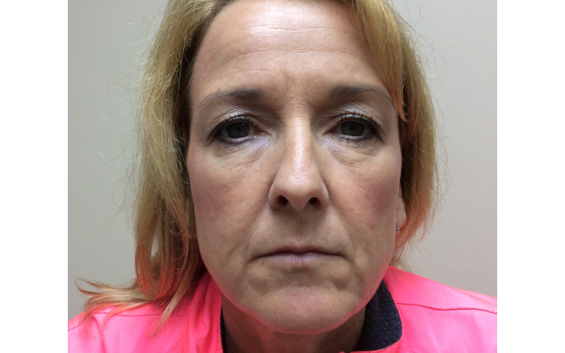 Forehead Wrinkles Before treatment