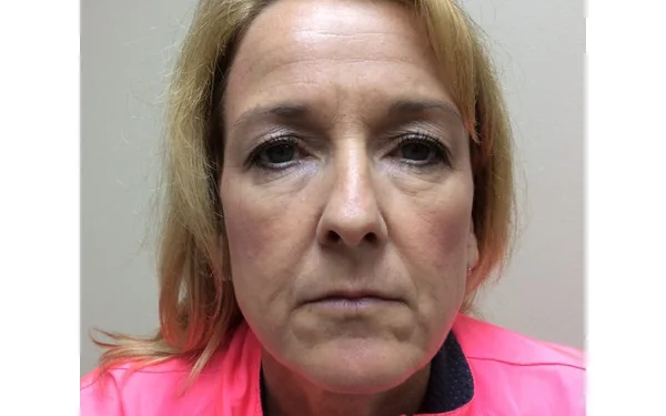 Forehead Wrinkles Before treatment