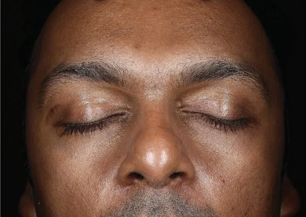 Forehead and cheek texture after 1 DiamondGlow treatment