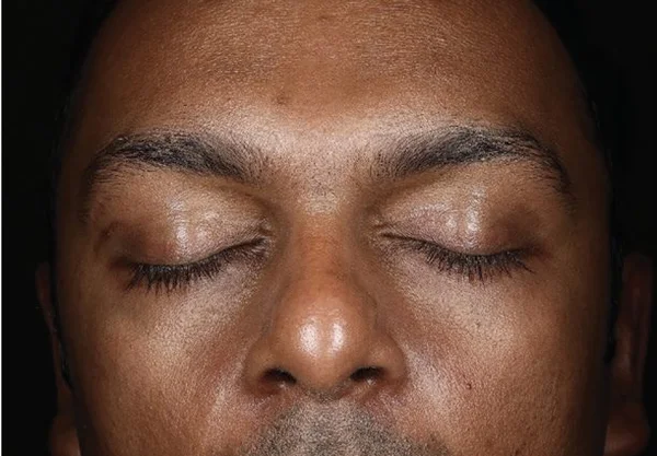 Forehead and cheek texture before DiamondGlow