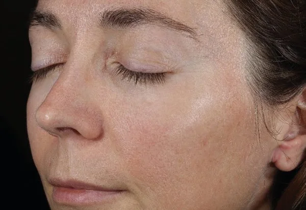 Texture, fine lines, and skin glow after 3 DiamondGlow treatments
