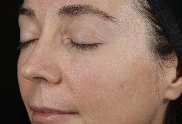 Texture, fine lines, and skin glow before DiamondGlow