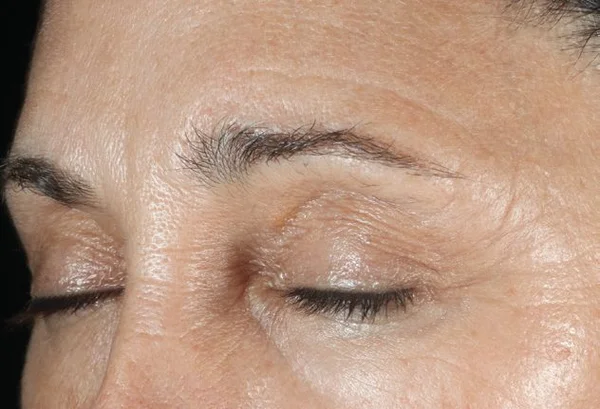 Brighter and smoother skin after 1 DiamondGlow treatment
