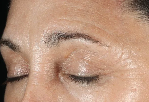 Dull and rough skin before DiamondGlow