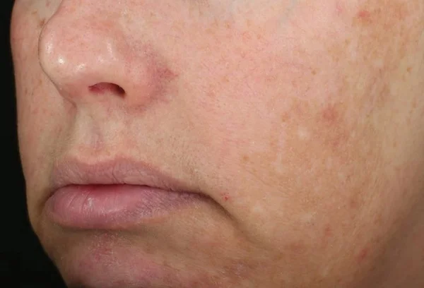 Improvement in visible hyperpigmentation after 3 DiamondGlow treatments