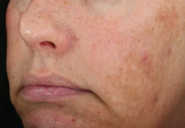 Hyperpigmentation and uneven tone before DiamondGlow