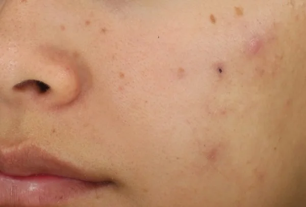 Clearer skin and reduced redness after 2 DiamondGlow treatments