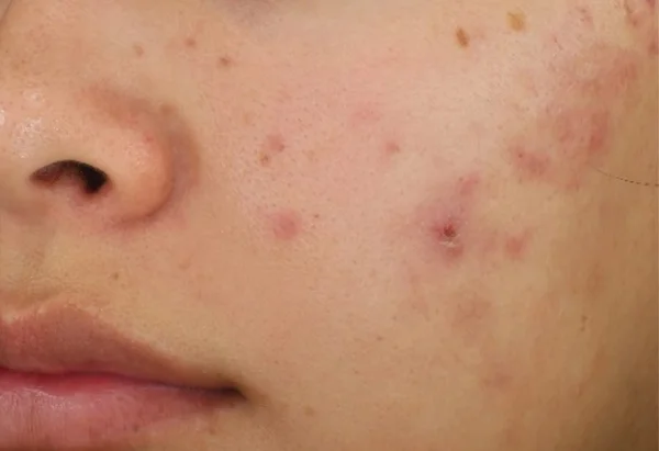 Congested skin and visible redness before DiamondGlow