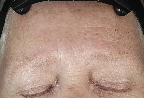 Visible reduction in forehead lines after 5 DiamondGlow treatments