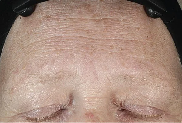 Forehead lines and wrinkles before DiamondGlow