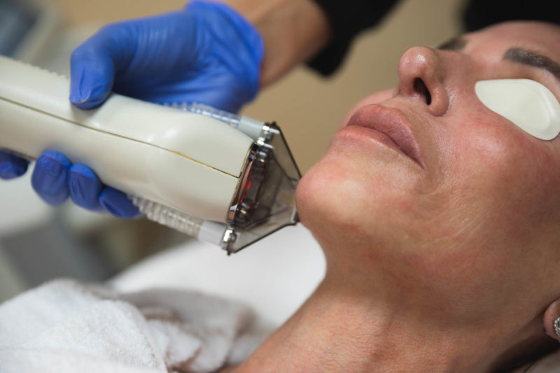 HALO Laser Resurfacing treatment at Marina Lifestyle Medicine