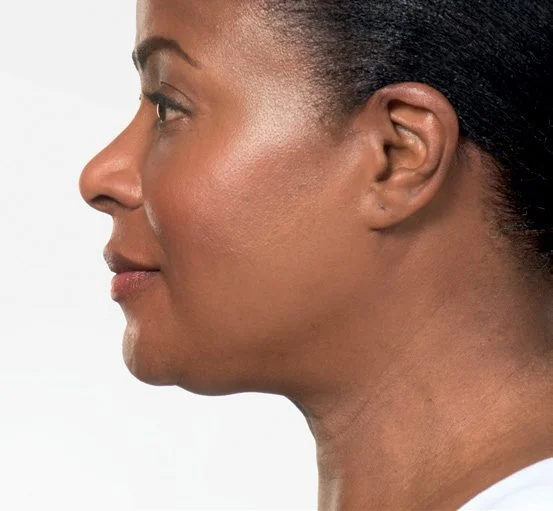 Adra after Kybella