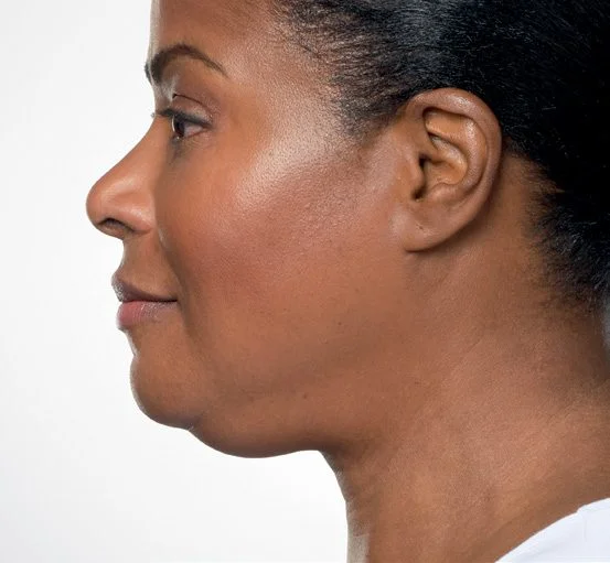 Adra before Kybella