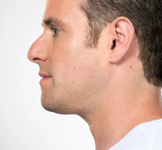 Jason after Kybella