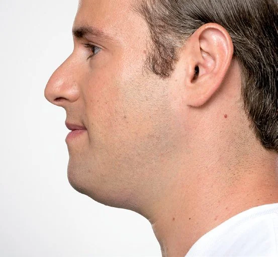 Jason before Kybella