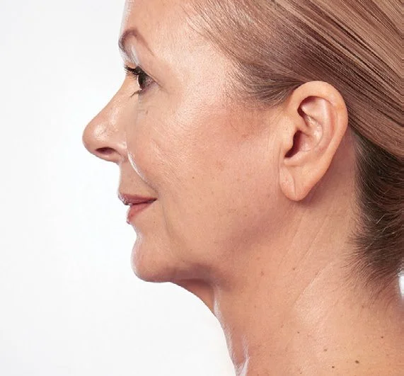 Marina after Kybella