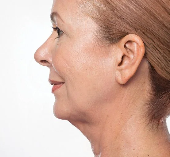 Marina before Kybella