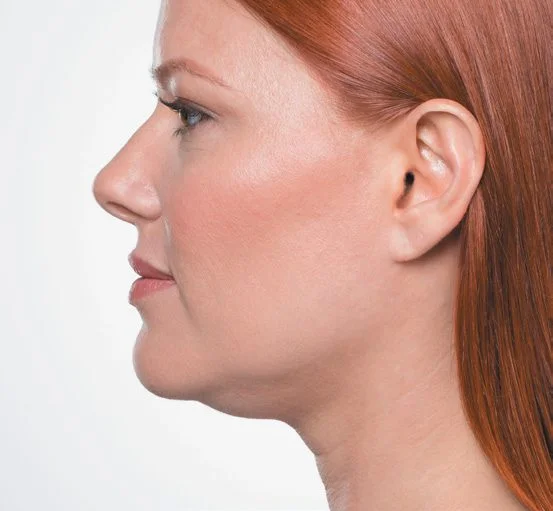 Ponti after Kybella