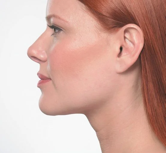 Ponti before Kybella